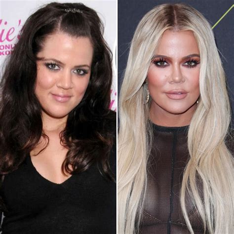 khloe kardashian before surgery photos.